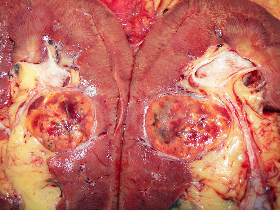 Sunitinib vs. nefrectomie gevolgd door sunitinib bij gemetastaseerd niercelcarcinoom
