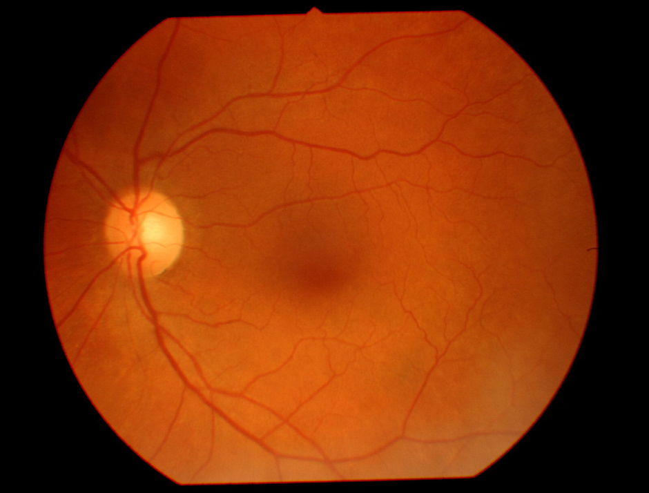 Dr. Google voorspelt cardiovasculaire risicofactoren door analyse van foto's van de oogfundus